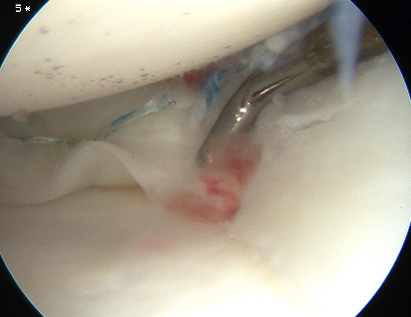 Meniscal Repair Posterior Fastfix Suture x 2